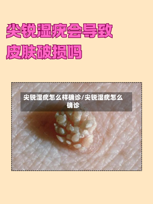 尖锐湿疣怎么样确诊/尖锐湿疣怎么确诊-第2张图片