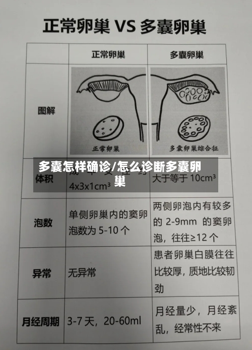 多囊怎样确诊/怎么诊断多囊卵巢