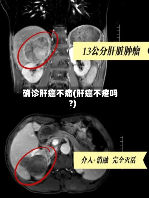 确诊肝癌不痛(肝癌不疼吗?)