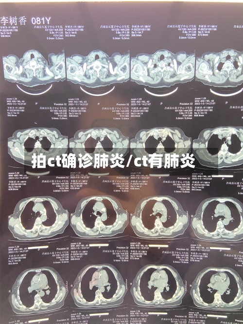 拍ct确诊肺炎/ct有肺炎