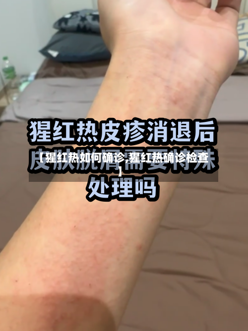 【猩红热如何确诊,猩红热确诊检查】