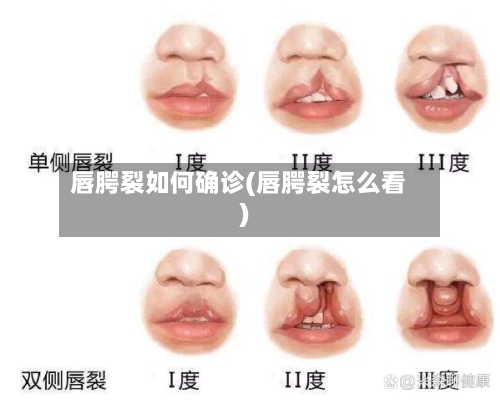 唇腭裂如何确诊(唇腭裂怎么看)-第2张图片
