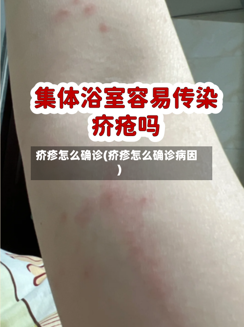 疥疹怎么确诊(疥疹怎么确诊病因)