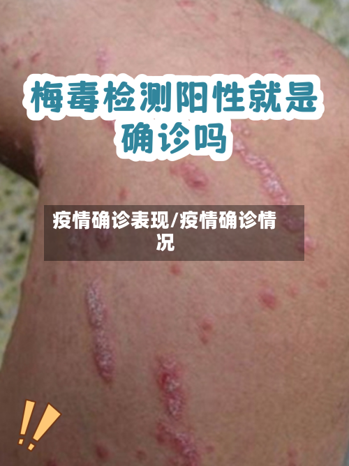 疫情确诊表现/疫情确诊情况