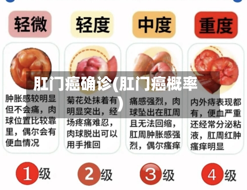 肛门癌确诊(肛门癌概率)-第2张图片