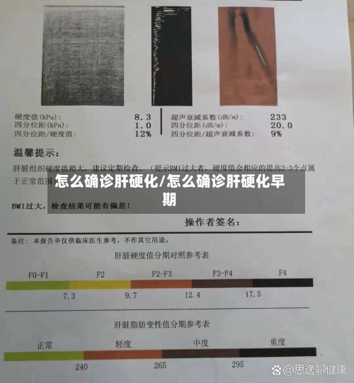 怎么确诊肝硬化/怎么确诊肝硬化早期-第2张图片