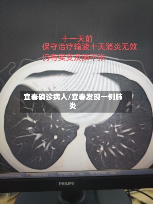 宜春确诊病人/宜春发现一例肺炎-第2张图片