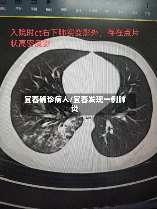 宜春确诊病人/宜春发现一例肺炎-第3张图片