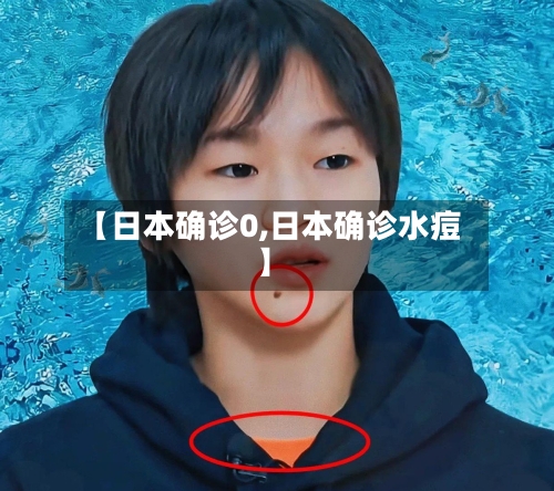 【日本确诊0,日本确诊水痘】