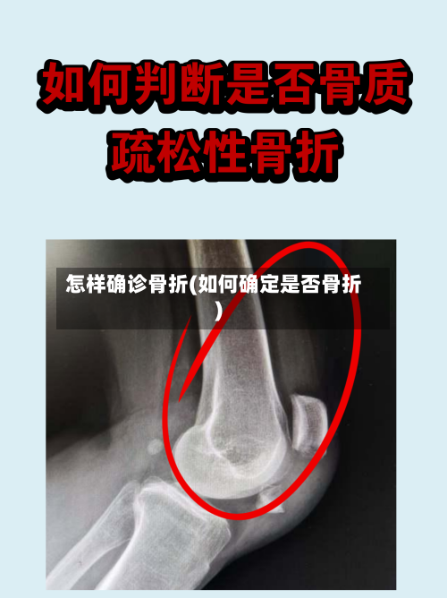 怎样确诊骨折(如何确定是否骨折)-第2张图片