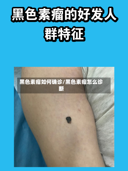 黑色素瘤如何确诊/黑色素瘤怎么诊断