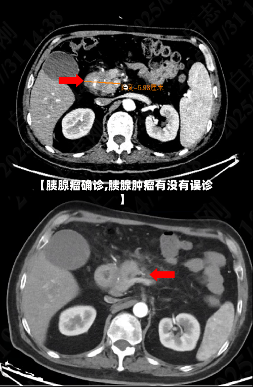 【胰腺瘤确诊,胰腺肿瘤有没有误诊】