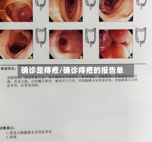确诊是痔疮/确诊痔疮的报告单