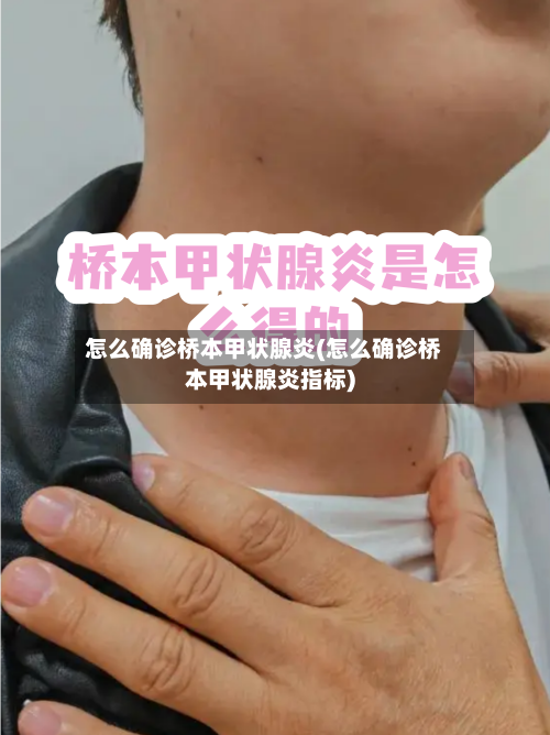 怎么确诊桥本甲状腺炎(怎么确诊桥本甲状腺炎指标)