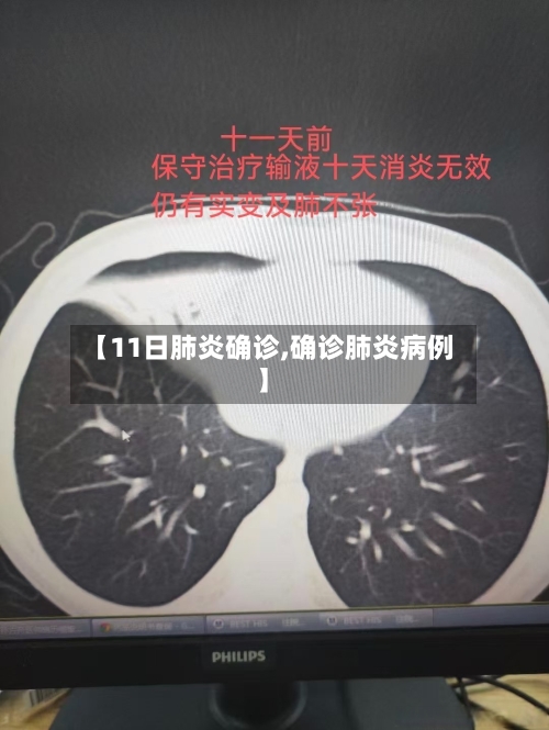 【11日肺炎确诊,确诊肺炎病例】-第2张图片
