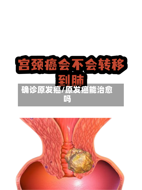 确诊原发癌/原发癌能治愈吗