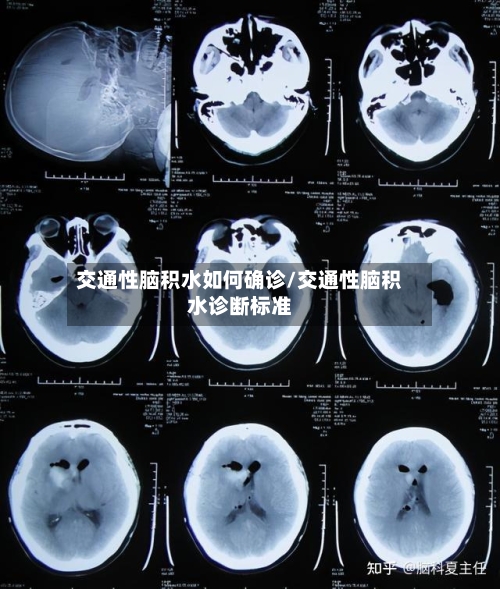 交通性脑积水如何确诊/交通性脑积水诊断标准