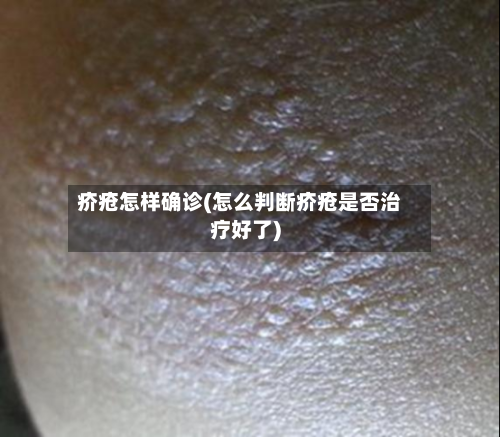 疥疮怎样确诊(怎么判断疥疮是否治疗好了)-第3张图片