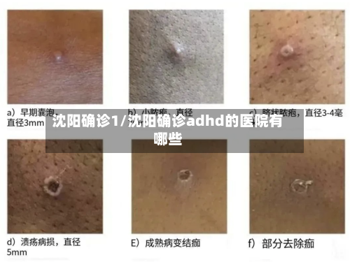 沈阳确诊1/沈阳确诊adhd的医院有哪些